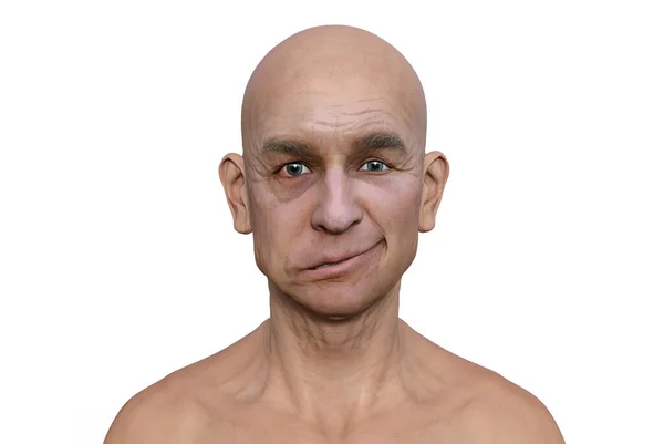 Facial Palsy Man Photorealistic Illustration Highlighting Asymmetry Drooping Facial Muscles — Stock Photo, Image