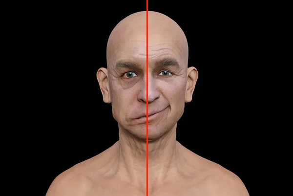 Facial palsy in a man, photorealistic 3D illustration highlighting the asymmetry and drooping of the facial muscles on one side of the face