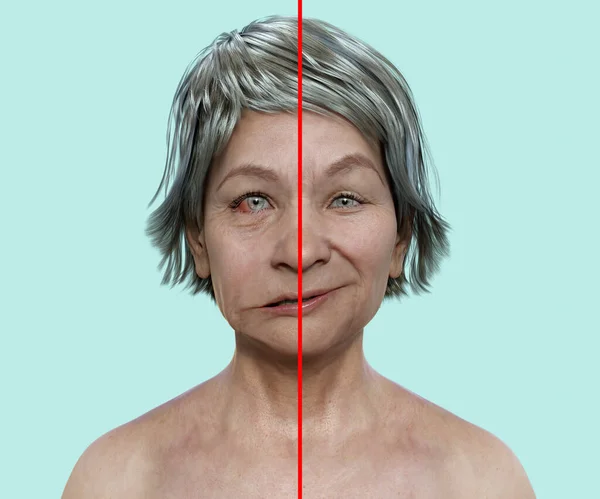 Facial palsy in a woman, photorealistic 3D illustration highlighting the asymmetry and drooping of the facial muscles on one side of the face