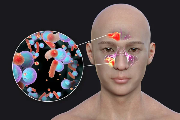 副鼻腔炎 超音速の炎症 副鼻腔炎を引き起こす細菌の人およびクローズアップビューで前頭葉および上顎洞炎の純粋な炎症を示す3Dイラスト — ストック写真