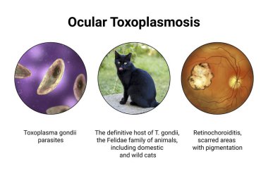 Göz toksoplazmozu, tek hücreli protozoan toxoplasma gondii 'nin sebep olduğu bir hastalık. Retina izini gösteren 3 boyutlu bilimsel çizimler