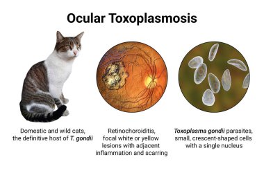 Göz toksoplazmozu, tek hücreli protozoan toxoplasma gondii 'nin sebep olduğu bir hastalık. Retina izini gösteren 3 boyutlu bilimsel çizimler