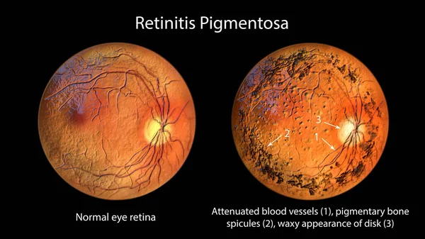 Retinitis Pigmentosa Una Enfermedad Genética Ocular Ilustración Muestra Retina Ocular — Foto de Stock