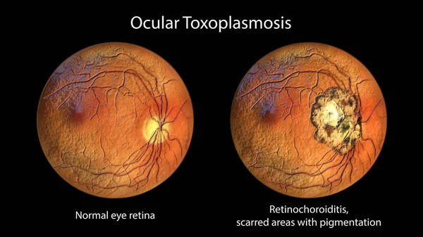 Retinal Scar Toxoplasmosis Disease Caused Single Celled Protozoan Toxoplasma Gondii — Stock Photo, Image