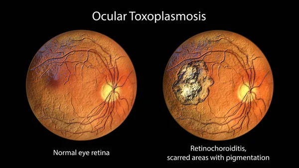 単細胞原虫のトキソプラズマゴンジイによる疾患であるトキソプラズマ症における網膜傷跡と 比較のための同じ健康的な眼網膜 眼鏡像 3Dイラスト — ストック写真