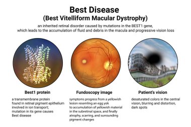En iyi hastalık. En iyi viteliform maküler distrofi, en iyi proteini gösteren 3 boyutlu illüstrasyon, retinada klasik fundoskopik yumurta sarısı lezyonu, ve hastada siyah noktalı bozuk görme.
