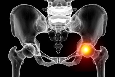 Hip joint pain. A 3D medical illustration depicting the pelvis and femur bones with the femur head highlighted in red, illustrating femur joint pain concept. clipart