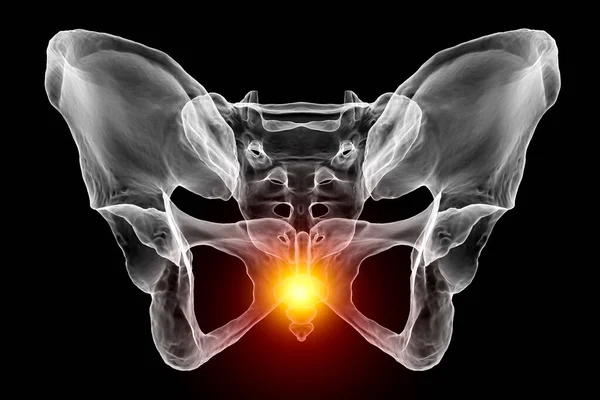 stock image A 3D medical illustration highlighting the coccyx bone marked in red, depicting coccyx pain which can occur due to injury, childbirth, or prolonged sitting. Front view