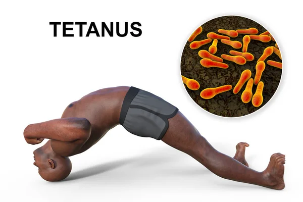 stock image A 3D medical illustration of a black-skinned man suffering from tetanus, shown in the opisthotonus position, with a close-up view of Clostridium tetani bacteria, the causative agent of tetanus.