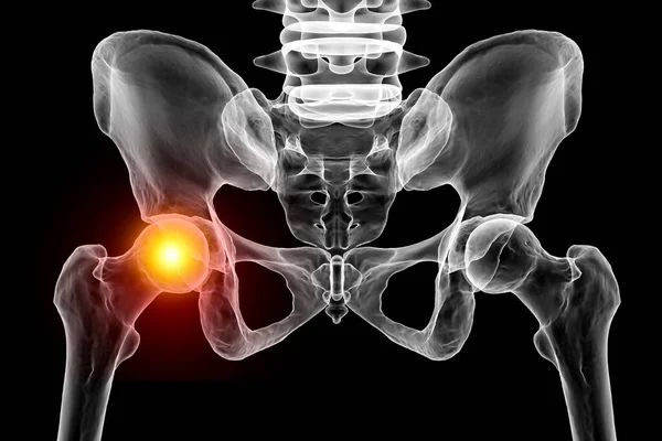 関節痛だ 骨盤と大腿骨の骨の頭部を赤く強調した3D医療用イラストで 大腿骨関節痛の概念を説明しています — ストック写真
