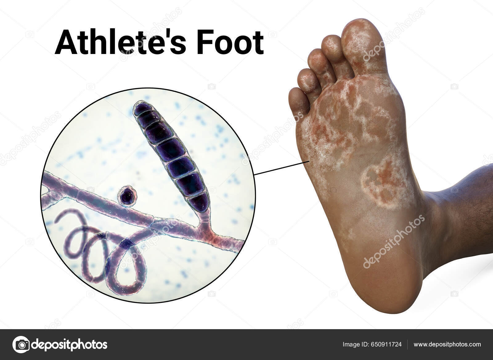 Uma Pessoa Pele Escura Com Micose Visão Perto Dos Fungos — Foto ©  katerynakon 650911724