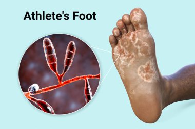 Mycosis 'li koyu tenli bir insanın ayağı ve Atletin ayağının 3D illüstrasyonuna neden olan mantar Epidermophyton floccosum' un yakın görüntüsü.