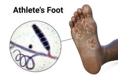 Mycosis 'i olan koyu tenli bir insanın ayağı ve atlet ayağına ve 3 boyutlu illüstrasyonuna neden olan Trichophyton zihinsel hücrelerine yakından bakmak.