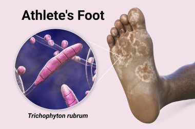 Mycosis 'li koyu tenli birinin ayağı ve atlet ayağına ve 3 boyutlu illüstrasyonuna neden olan Trichophyton rubrum' un yakından görüntüsü.