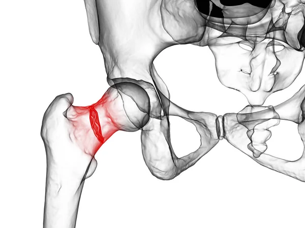 典型的には高齢者で発生し モビリティの問題や他の合併症につながる可能性が股関節の一般的なタイプである大腿骨首の骨折 白の背景に分離 3Dイラスト — ストック写真