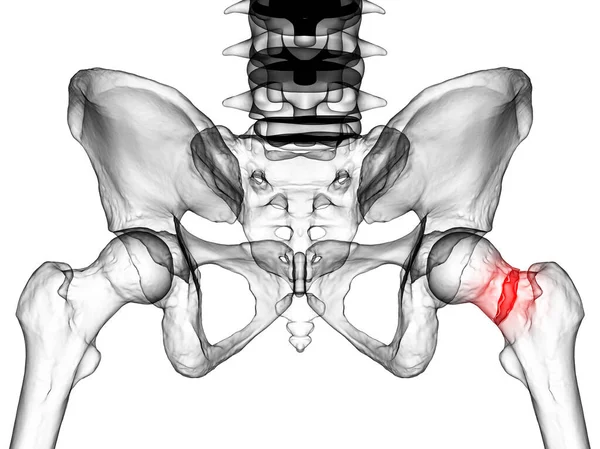 股骨颈骨折 一种常见的髋关节骨折 通常发生在老年人身上 并可能导致行动障碍和其他并发症 — 图库照片
