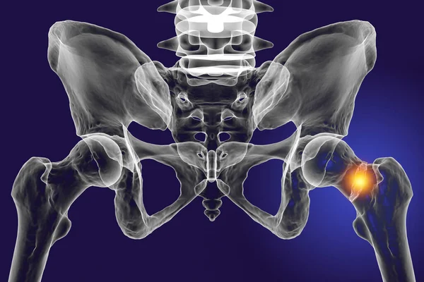 股骨颈骨折 一种常见的髋关节骨折 通常发生在老年人身上 并可能导致行动障碍和其他并发症 — 图库照片