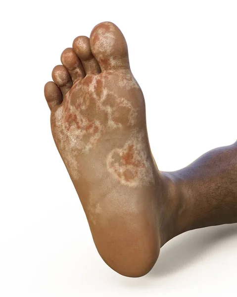 Πόδι Ενός Σκουρόχρωμου Ανθρώπου Μυκητίαση Κάτω Όψη Εικονογράφηση — Φωτογραφία Αρχείου