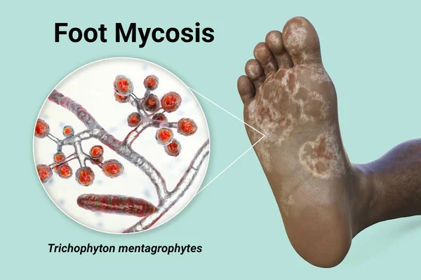 Foot Dark Skinned Person Mycosis Close View Fungi Trichophyton Mentagrophytes — Stock Photo, Image