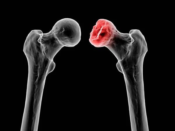 女性の頭部への血液供給に影響を与える小児の股関節疾患であるLegg Calve Pertes Diseaseの影響を受けた大腿骨骨の骨 3Dイラストは左大腿骨の骨に影響を与えます 画像の右側 — ストック写真