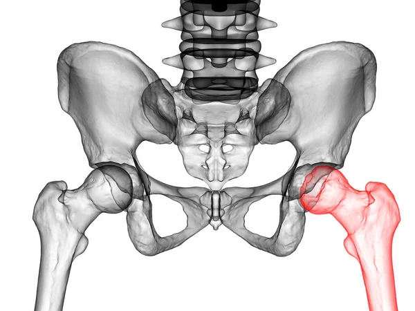 Femur Bone Affected Legg Calve Perthes Disease Childhood Hip Disorder — Stock Photo, Image
