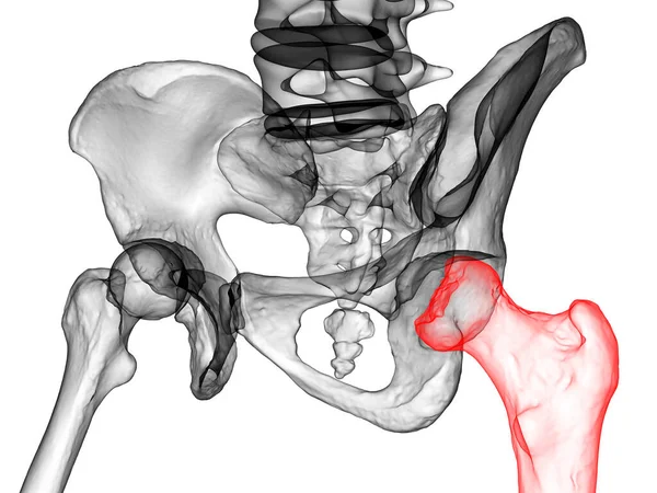 Femur Bone Affected Legg Calve Perthes Disease Childhood Hip Disorder — Stock Photo, Image