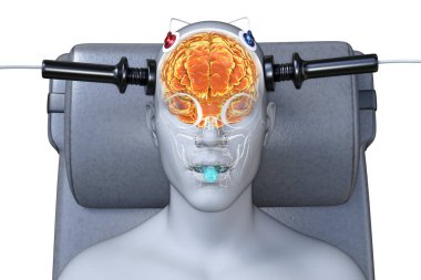 Elektrokonvülsif terapi, elektrokonvülsif terapi, beyin uyarılması için elektrik akımlarının kullanıldığı ağır akıl hastalıkları için kullanılan bir tedavi, 3 boyutlu illüstrasyon.