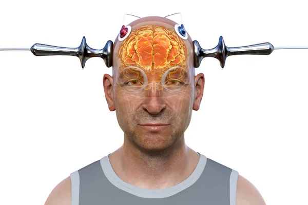 stock image Electroconvulsive therapy, ECT, a treatment used for severe mental illnesses involving the use of electrical currents to stimulate the brain, 3D illustration