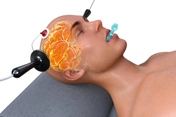 Electroconvulsive Therapy Ect Treatment Used Severe Mental Illnesses Involving Use — Stock Photo, Image