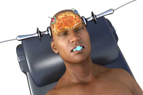 stock image Electroconvulsive therapy, ECT, a treatment used for severe mental illnesses involving the use of electrical currents to stimulate the brain, 3D illustration