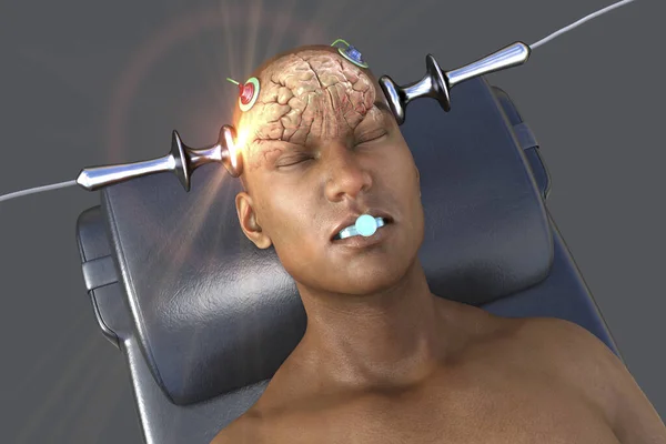 stock image Electroconvulsive therapy, ECT, a treatment used for severe mental illnesses involving the use of electrical currents to stimulate the brain, 3D illustration