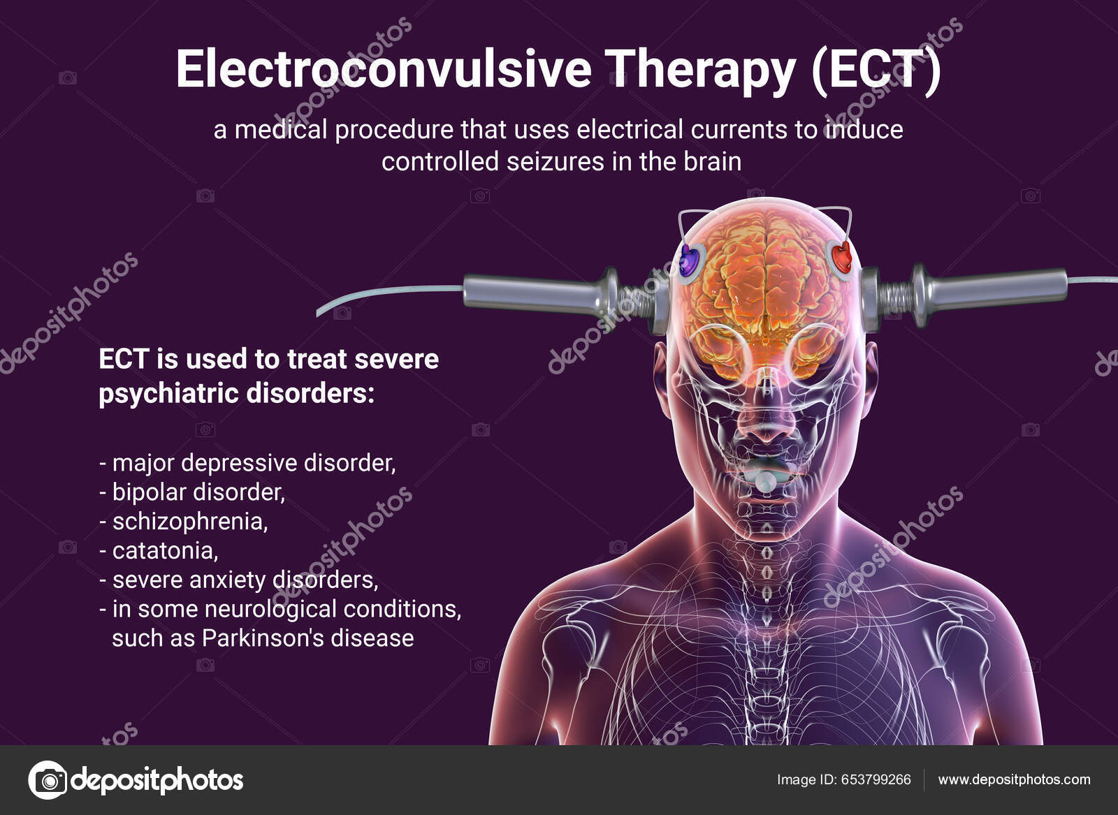 电休克疗法Ect 一种用电流刺激大脑的治疗严重精神疾病的疗法——图库图片© katerynakon #653799266