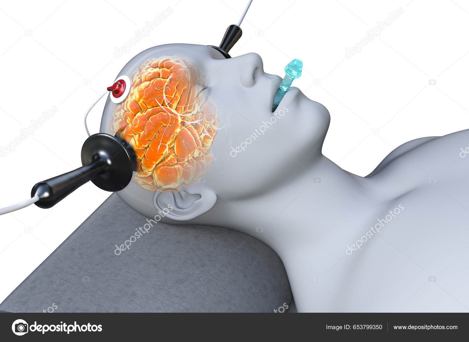 电休克疗法Ect 一种用电流刺激大脑的治疗严重精神疾病的疗法——图库图片© katerynakon #653799350