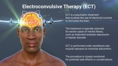 Elektrokonvülsif terapi, elektrokonvülsif terapi, beyin uyarılması için elektrik akımlarının kullanıldığı ağır akıl hastalıkları için kullanılan bir tedavi, 3 boyutlu illüstrasyon.