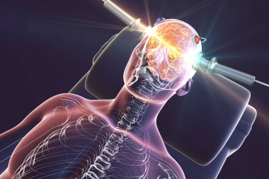 Electroconvulsive therapy, ECT, a treatment used for severe mental illnesses involving the use of electrical currents to stimulate the brain, 3D illustration clipart