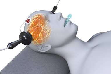 Electroconvulsive therapy, ECT, a treatment used for severe mental illnesses involving the use of electrical currents to stimulate the brain, 3D illustration clipart