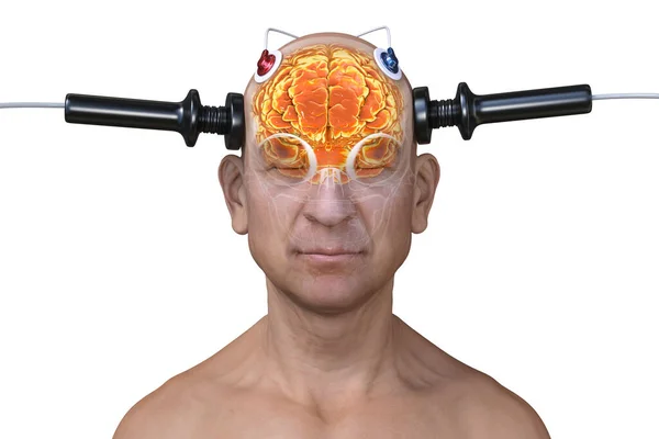 Electroconvulsive Therapy Ect Treatment Used Severe Mental Illnesses Involving Use — Stock Photo, Image