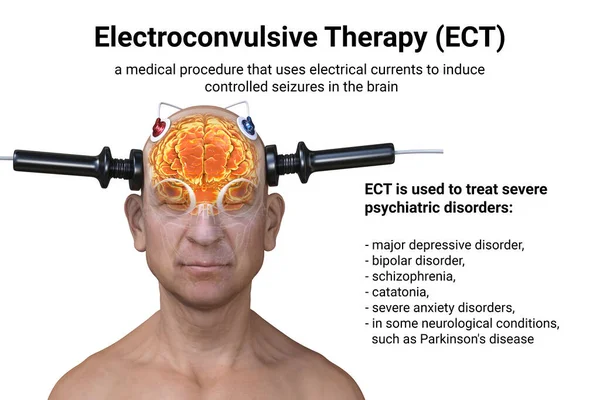 Elektrokonvulzív Terápia Ect Súlyos Mentális Betegségek Kezelésére Használják Beleértve Elektromos — Stock Fotó