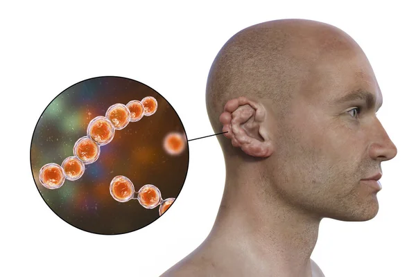 顕微鏡的真菌による慢性皮膚疾患であるロボミコシスラカシア ロボイは 主に手足や耳に影響を及ぼす結節性およびケロイド性病変を特徴とし フォトリアリスティック3Dイラスト — ストック写真