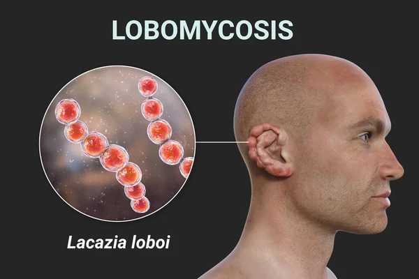 Lobomycose Een Chronische Huidziekte Veroorzaakt Door Microscopische Schimmels Lacazia Loboi — Stockfoto
