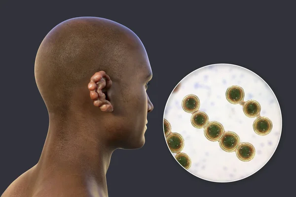 放线菌病是一种慢性皮肤病 由微小真菌Lacazia Loboi引起 主要表现为结节和红斑 主要影响四肢和耳朵 — 图库照片