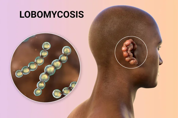Lobomycosis Chronic Skin Disease Caused Microscopic Fungi Lacazia Loboi Characterized — Stock Photo, Image