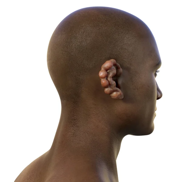 Nódulos Lobomicose Auricular Uma Doença Crônica Pele Causada Por Fungos — Fotografia de Stock