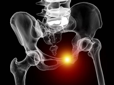 Simfizis pubis disfonksiyonu, leğen kemikleri gösteren 3 boyutlu illüstrasyon ve kırmızı kasık simfizisinde vurgulanmış.