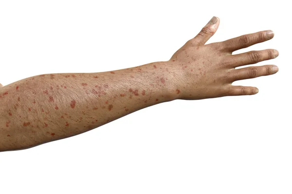 マーブルク出血熱患者の腕の皮膚発疹 フォトリアリスティック3Dイラスト — ストック写真