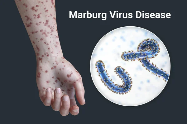 Ihottuma Marburgin Verenvuotokuumetta Sairastavan Potilaan Käsivarressa Lähikuva Marburgin Viruspartikkelista Kuva — kuvapankkivalokuva