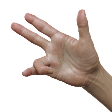 Dupuytren kasılmaları olan kadın bir hastanın eli, parmakları avuç içine doğru büken bir durum, fotorealistik üç boyutlu resimleme.