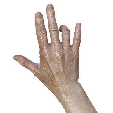 Dupuytren kasılmaları olan kadın bir hastanın eli, parmakları avuç içine doğru büken bir durum, fotorealistik üç boyutlu resimleme.