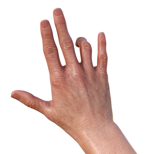 Рука Пацієнтки Стисканням Дюпюітрен Стан Який Змушує Пальці Згинатися Пальми — стокове фото