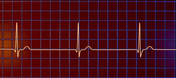 Elektrokardiogram Ekg Zobrazující Junkční Rytmus Kterému Dochází Když Elektrické Signály — Stock fotografie